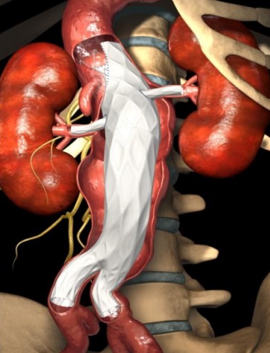 The Ventana Fenestrated Stent Graft System from Endologix
